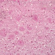 Perspective of Chilean – French collaboration in chronic illness and ageing: The case of brain disorders