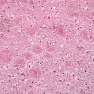 Perspective of Chilean – French collaboration in chronic illness and ageing: The case of brain disorders